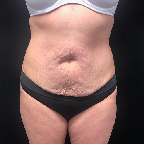 Abdominoplasty 14 Before Photo