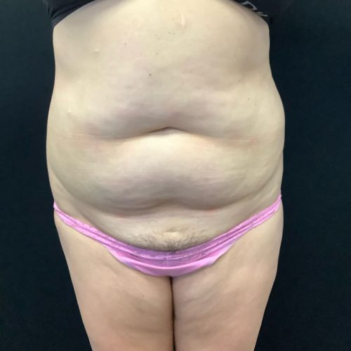 Abdominoplasty 15 Before Photo