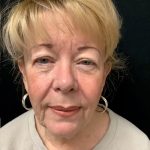 Blepharoplasty 08 Before Thumbnail Photo