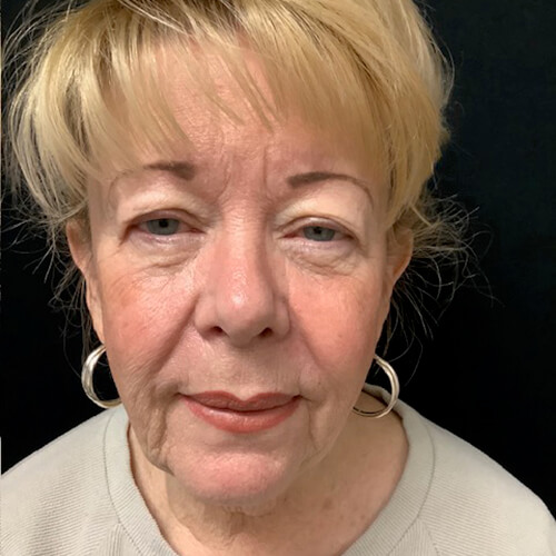 Blepharoplasty 08 Before Photo