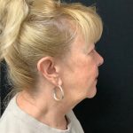 Blepharoplasty 08 Before Thumbnail Photo