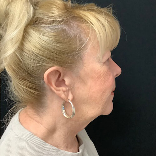 Blepharoplasty 08 Before Photo