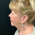 Blepharoplasty 08 Before Thumbnail Photo