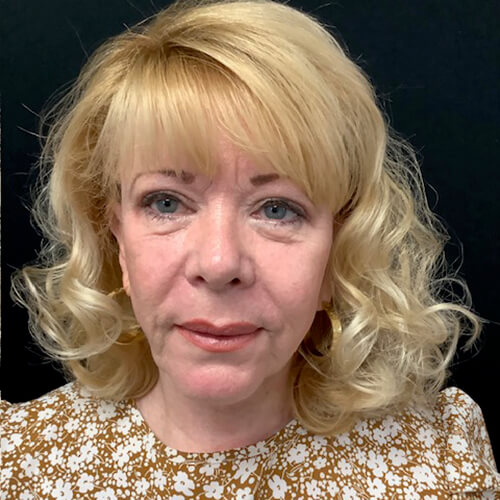 Blepharoplasty 08 After Photo