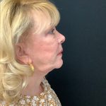 Blepharoplasty 08 After Thumbnail Photo