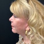 Blepharoplasty 08 After Thumbnail Photo