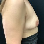 Breast Augmentation Patient 27 Before Thumbnail Photo