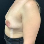 Breast Augmentation Patient 27 Before Thumbnail Photo