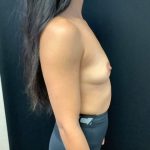 Breast Augmentation Patient 28 Before Thumbnail Photo