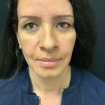 Rhinoplasty 08 Before Thumbnail Photo