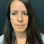 Rhinoplasty 08 After Thumbnail Photo