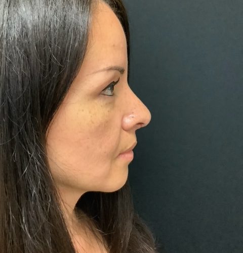 Rhinoplasty 08 After Photo