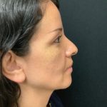 Rhinoplasty 08 Before Thumbnail Photo