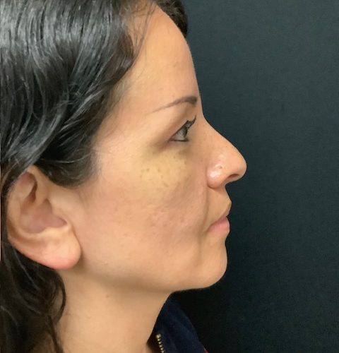 Rhinoplasty 08 Before Photo