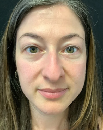 Rhinoplasty 07 Before Photo