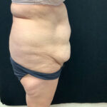 Abdominoplasty 16 Before Thumbnail Photo