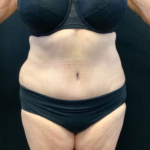 Abdominoplasty 16 After Photo