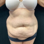 Abdominoplasty 16 Before Thumbnail Photo
