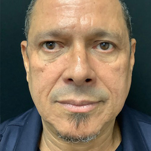 Blepharoplasty 09 After Photo