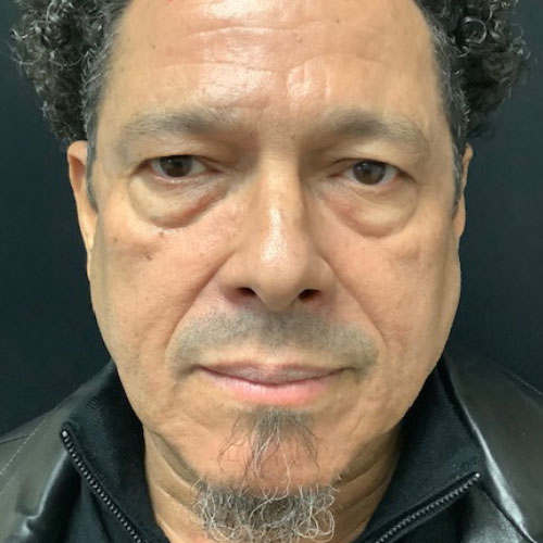 Blepharoplasty 09 Before Photo