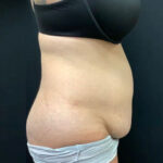 Abdominoplasty 18 Before Thumbnail Photo
