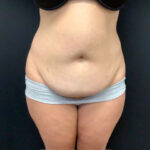 Abdominoplasty 18 Before Thumbnail Photo