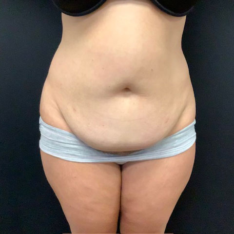 Abdominoplasty 18 Before Photo