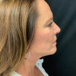 Neck Lift 02 After Thumbnail Photo