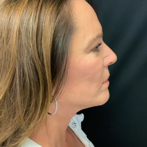 Neck Lift 02 After Photo