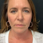 Neck Lift 02 After Thumbnail Photo