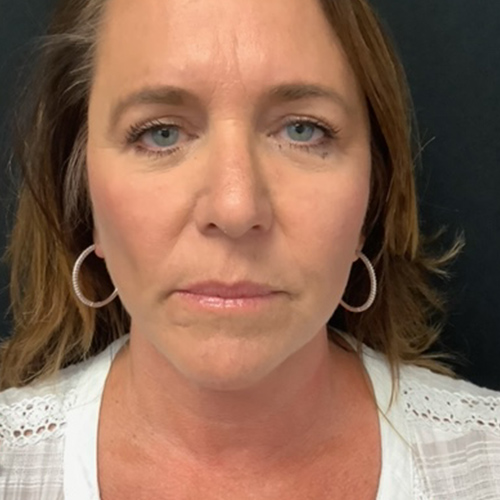 Neck Lift 02 After Photo