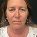 Neck Lift 02 Before Thumbnail Photo