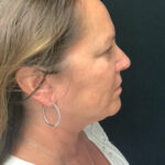 Neck Lift 02 Before Thumbnail Photo