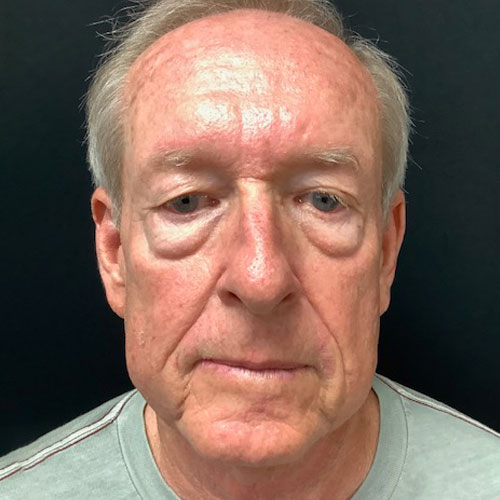 Blepharoplasty 11 Before Photo